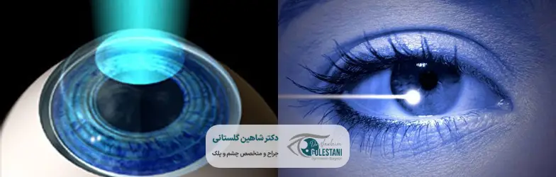 تفاوت جراحی های لیزیک، لازک و پی آر کی