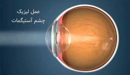 عمل لیزیک چشم آستیگماتیسم