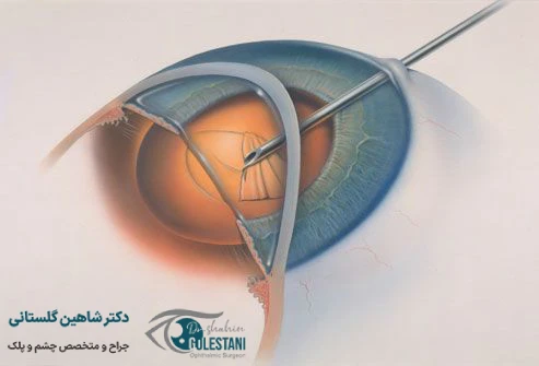 عمل آب مروارید