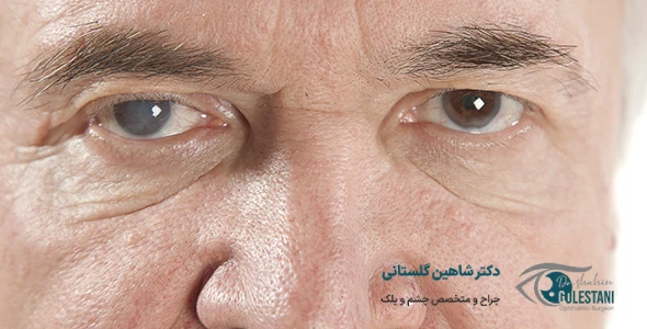 عمل آب مروارید - کاتاراکت