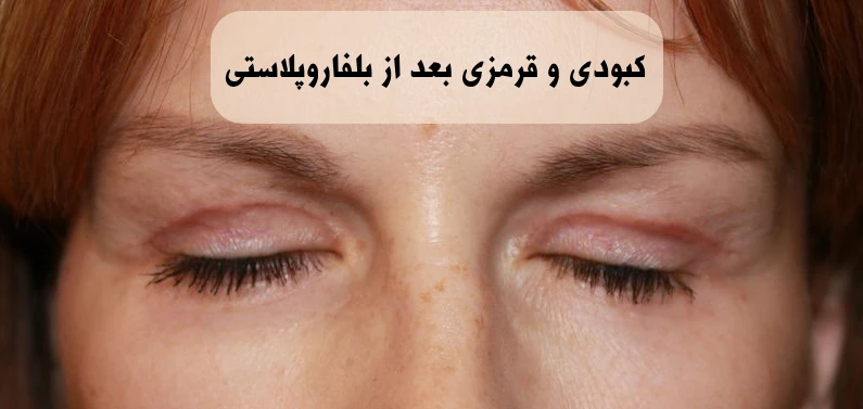 کبودی و قرمزی بعد از بلفاروپلاستی