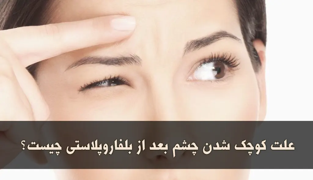 علت کوچک شدن چشم بعد از بلفاروپلاستی