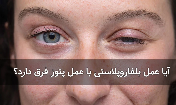تفاوت عمل پتوز و بلفاروپلاستی تفاوت عمل پتوز و بلفاروپلاستی