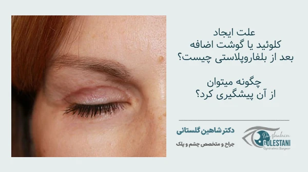 پیشگیری از ایجاد گوشت اضافه بعد از بلفاروپلاستی