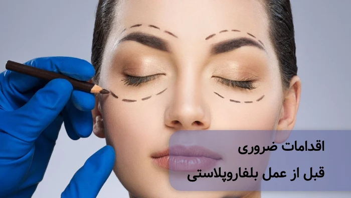 اقدامات قبل از بلفاروپلاستی