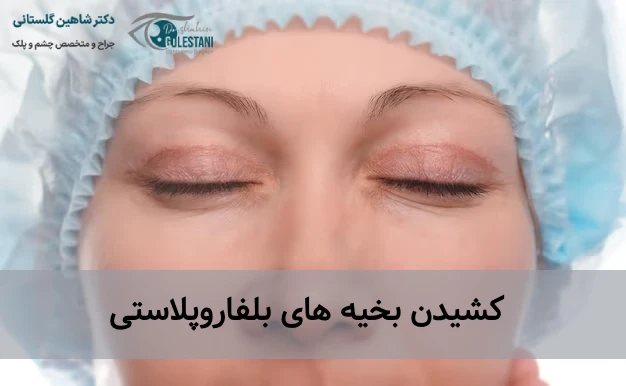کشیدن بخیه های بلفاروپلاستی