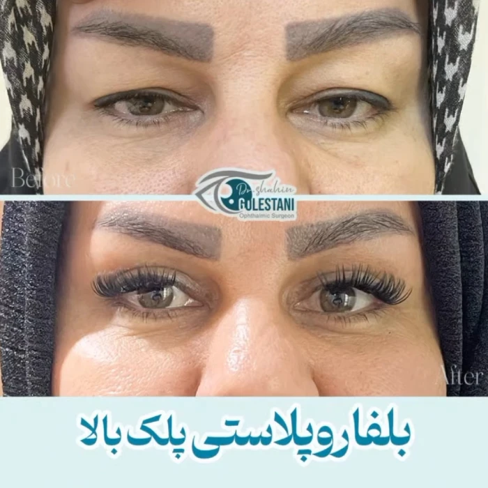 جراحی پلک بالا