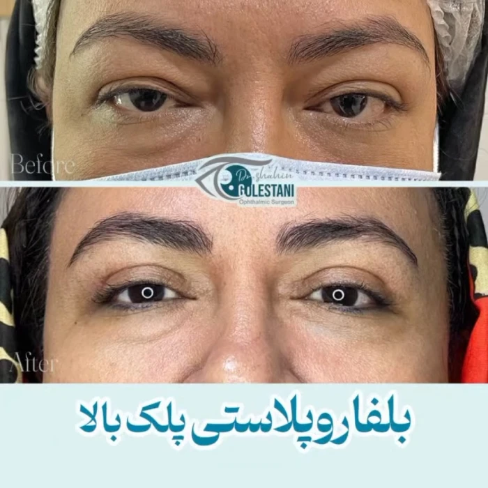 جراحی پلک بالا