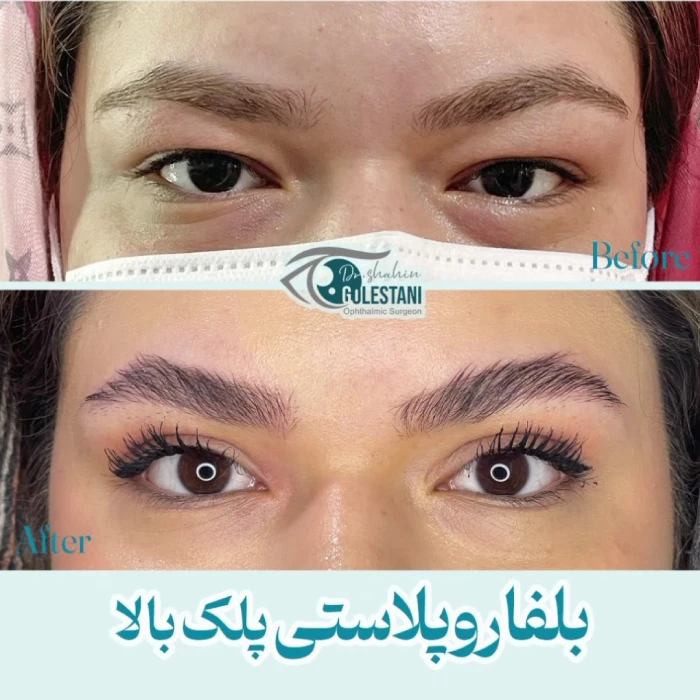 رفع دائمی پف پلک بالا