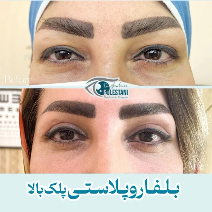 نمونه کار جراحی افتادگی پلک بالا