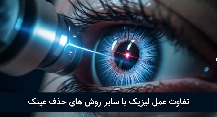 عمل لیزیک چشم