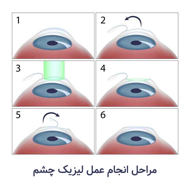 مراحل انجام عمل لیزیک