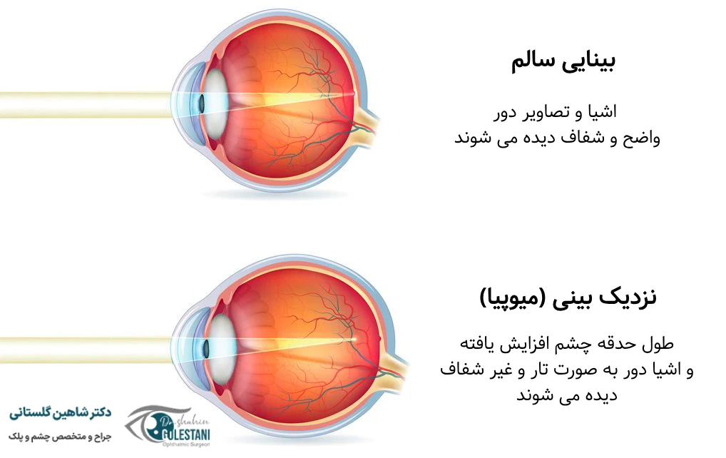 نزدیک بینی و انواع آن