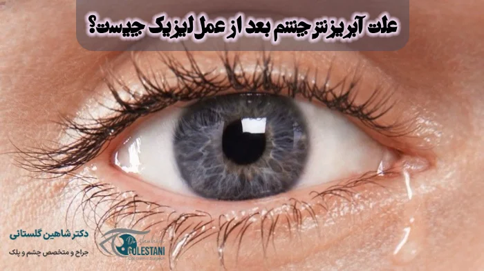 علت ریزش اشک بعد از عمل لیزیک